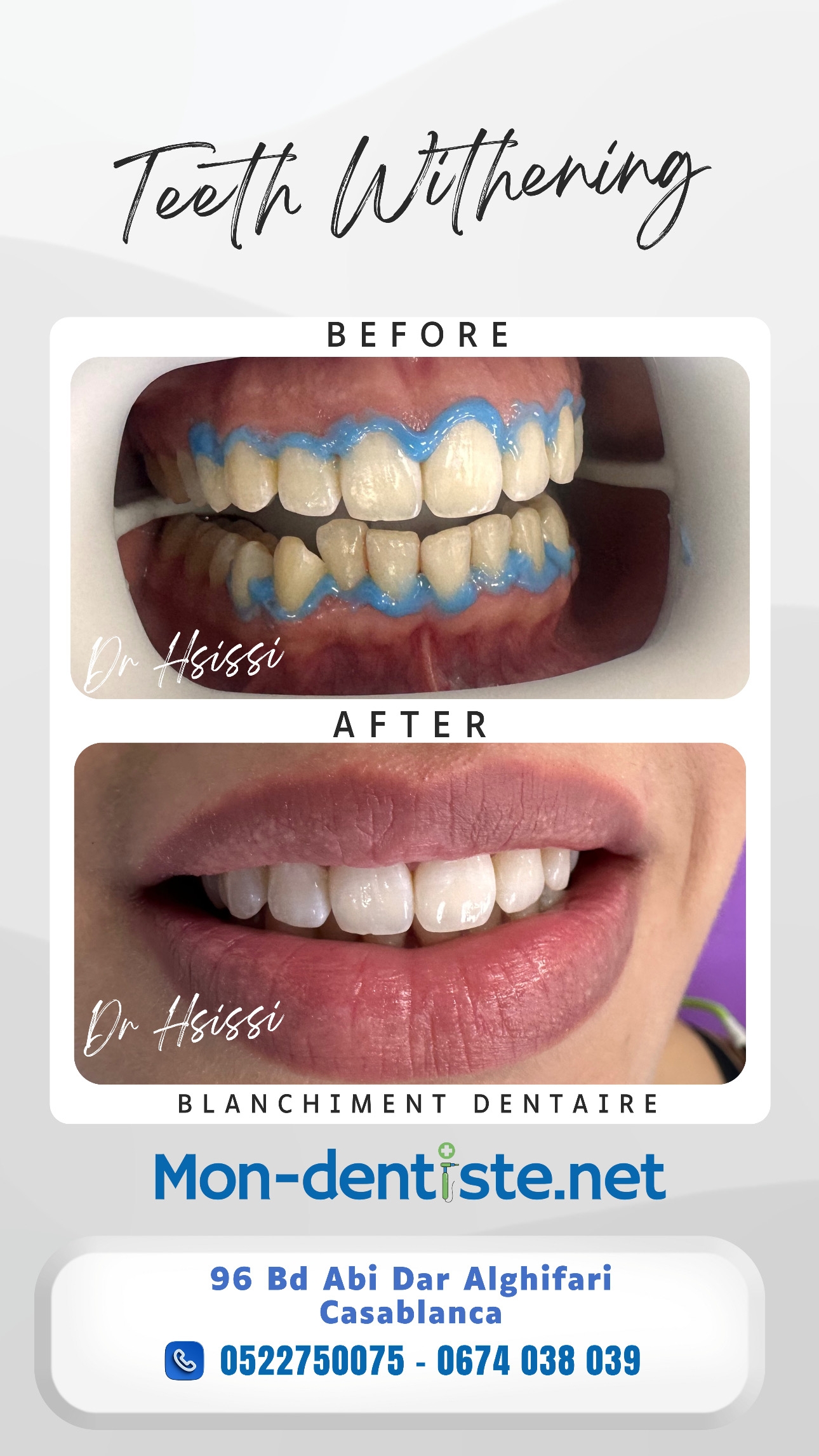 Centre Dentaire Dr Hsissi Issam - sidi El Bernoussi Casablanca - Esthétique de sourire -Soins Dentaires -Chirurgie - Couronnes et prothèse - atteintes de la gencive et du parodonte -Orthodontie - Pédodontie 