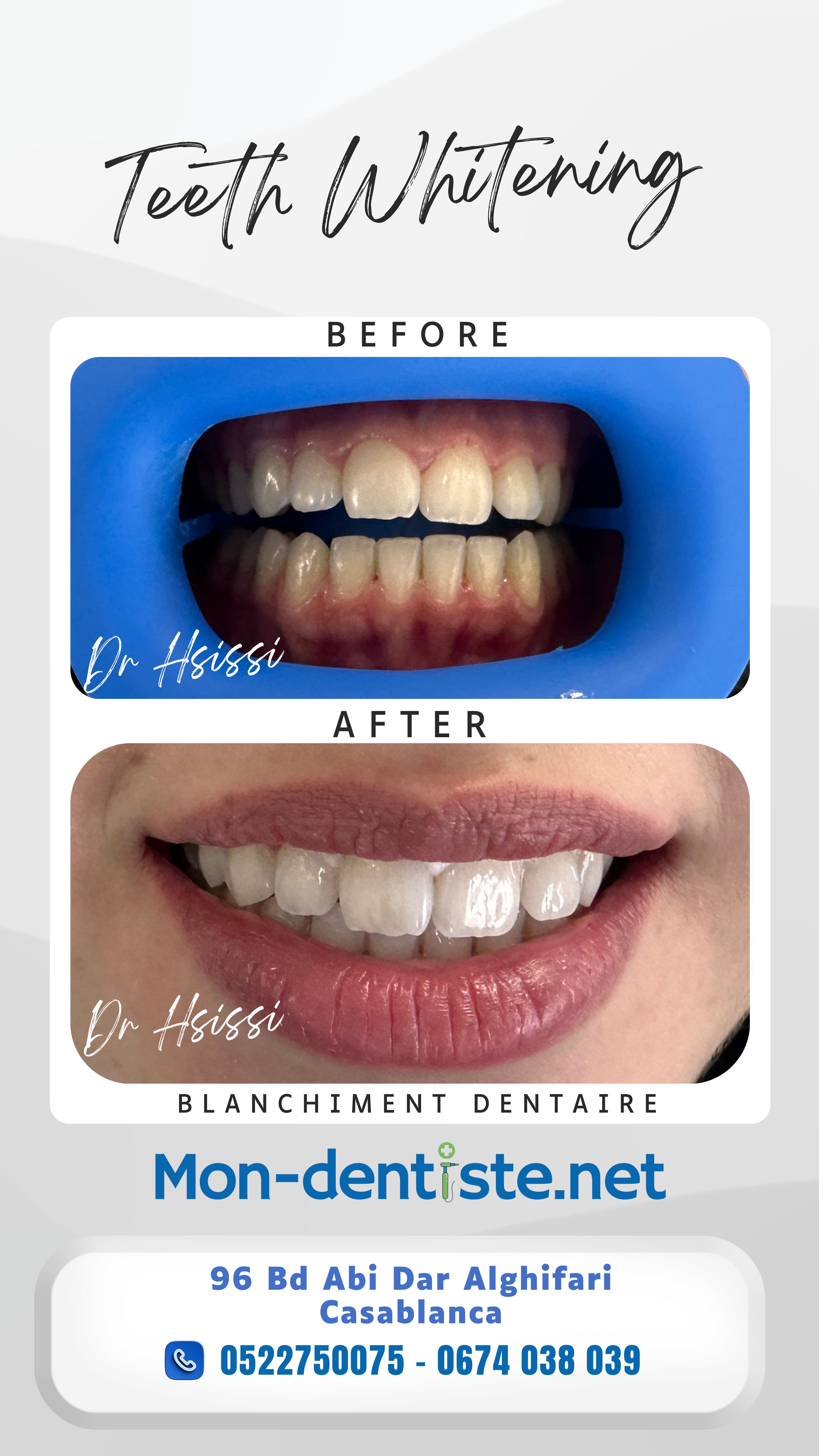 Centre Dentaire Dr Hsissi Issam - sidi El Bernoussi Casablanca - Esthétique de sourire -Soins Dentaires -Chirurgie - Couronnes et prothèse - atteintes de la gencive et du parodonte -Orthodontie - Pédodontie 